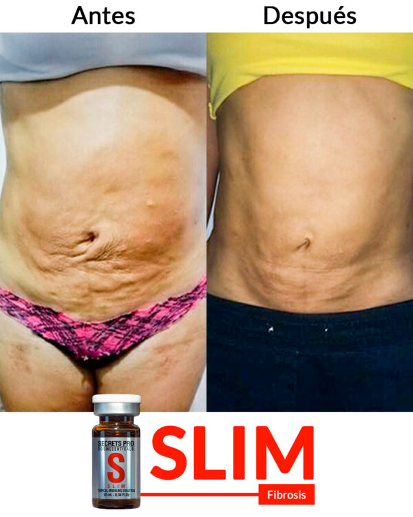 Fibrosis-__ Slim