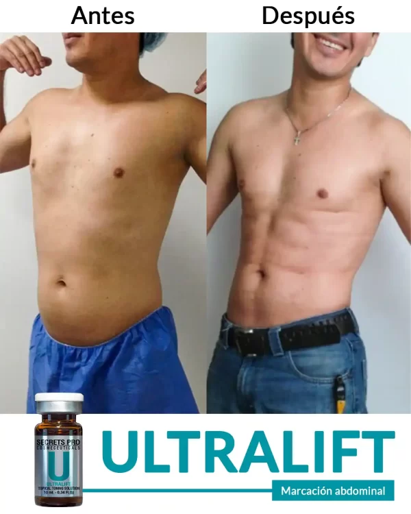 Ultralift