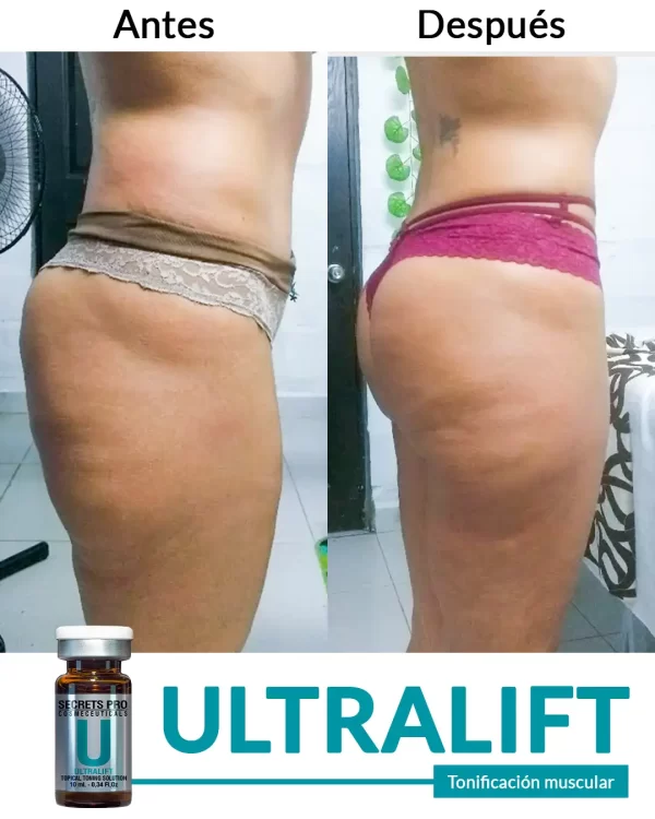 Ultralift