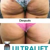 Ultralift