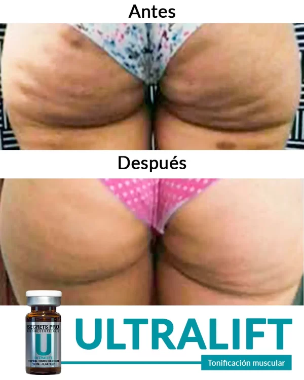 Ultralift