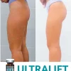 Ultralift