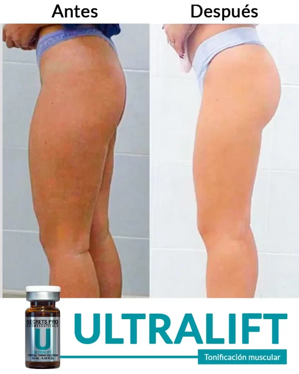 Ultralift